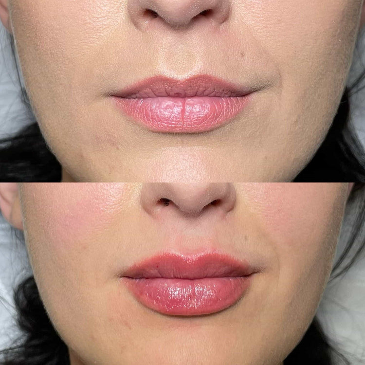 Are Lip Injections Safe for All Skin Types?